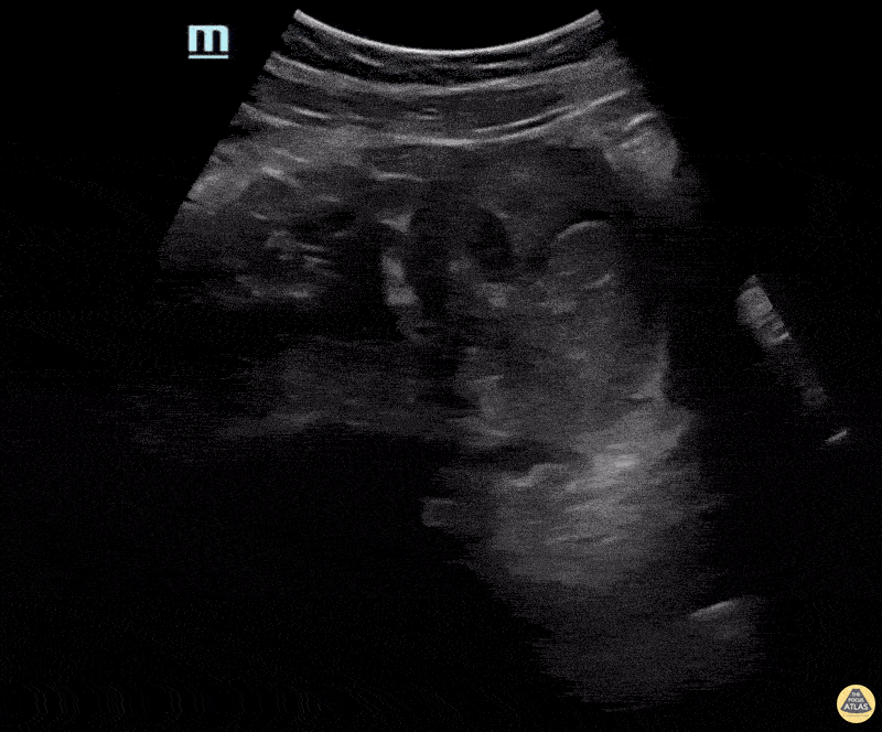 OB/Gyn - Partial Molar Pregnancy Long