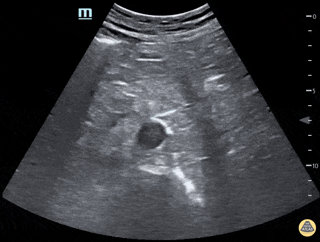 Renal/GU - Horseshoe Kidney Transverse