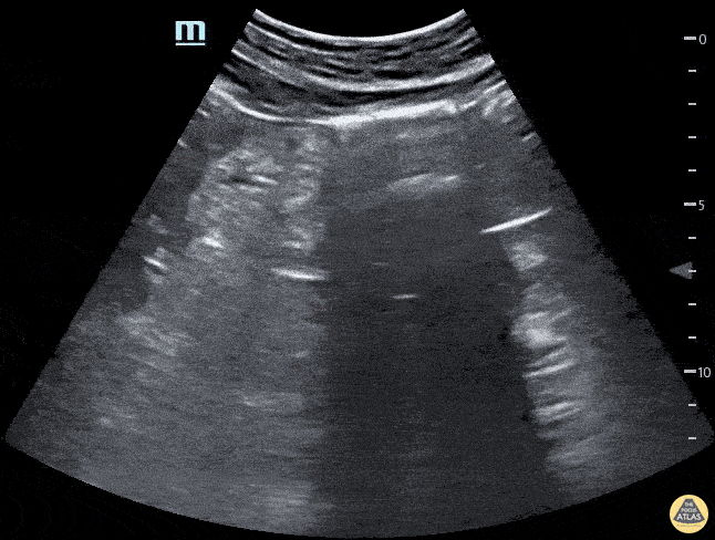 Renal/GU - Horseshoe Kidney Longitudinal