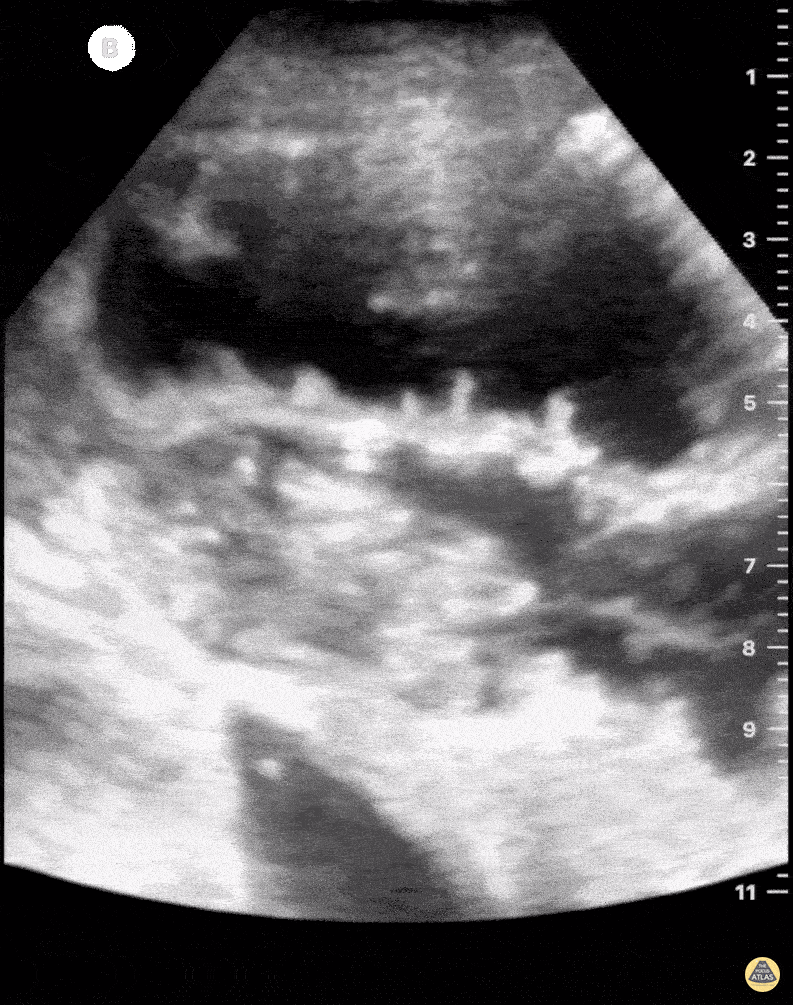 Bowel-GI - Obstrução de Delgado - To and Fro sign