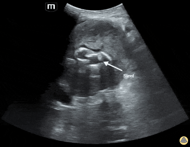 Aorta - Aortic Aneurysm with endoleak