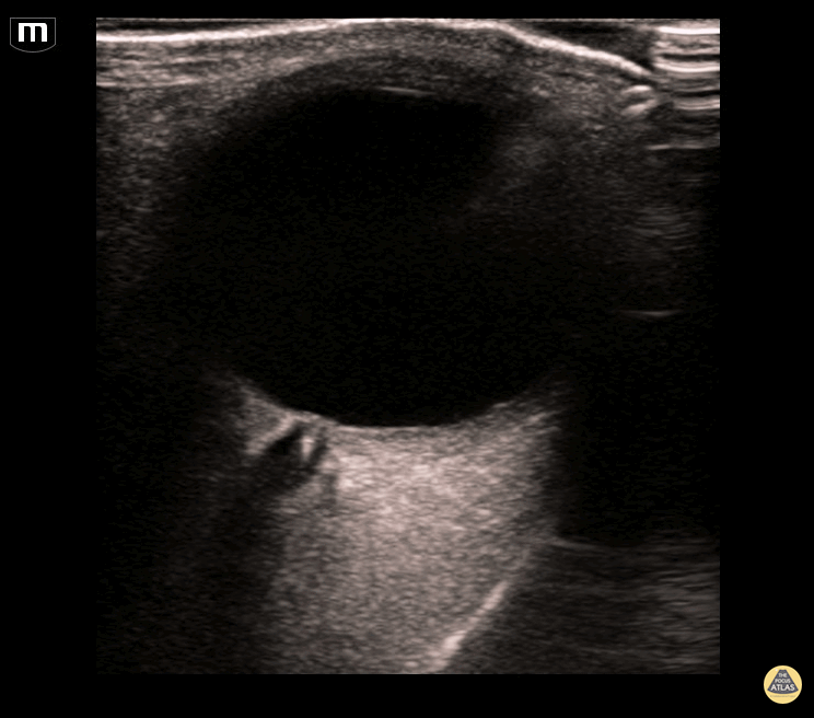Orbital - Diagnosis of CRAO on POCUS