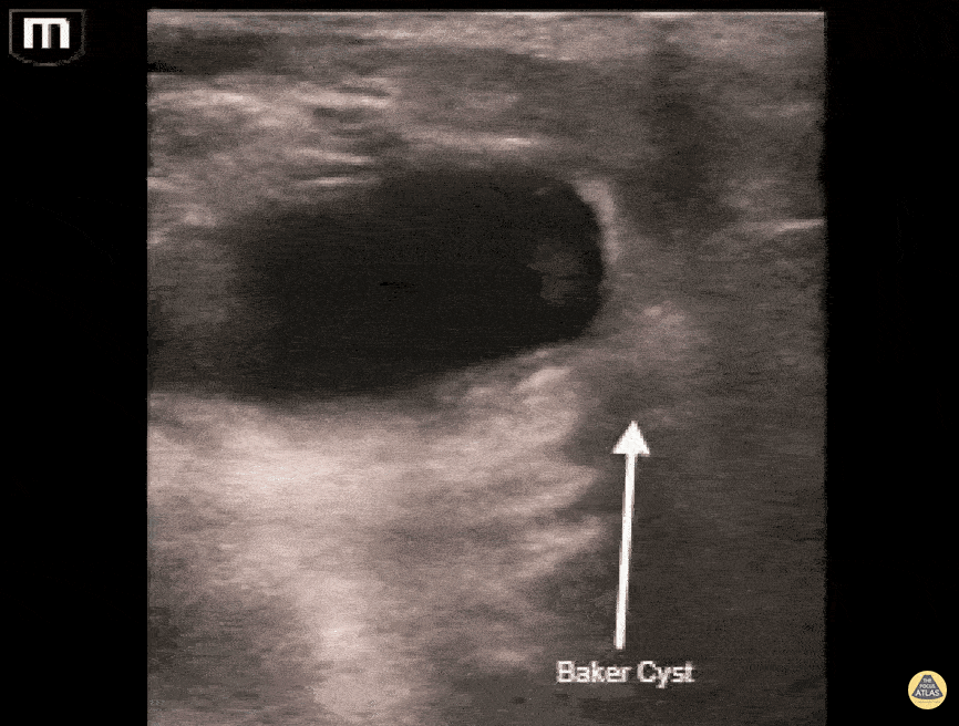 Musculoskeletal - Baker's cyst causing leg pain