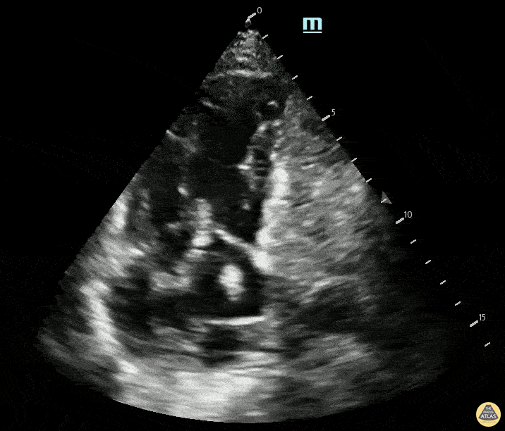 Right Ventricular Dysfunction - Apical 4 Chamber view demonstrating massive PE with RV dilation, D-sign, and McConnel sign with clot in transit