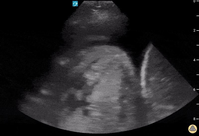 Pulmonary - Large pleural effusion with hiatal hernia