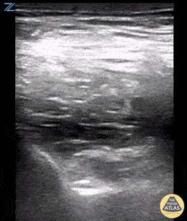 Nerve Block Gallery - PENG Block