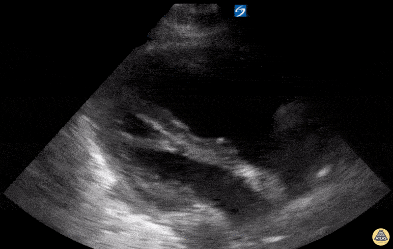 Right Ventricular Dysfunction - RV Strain with RV dilation on PSLA