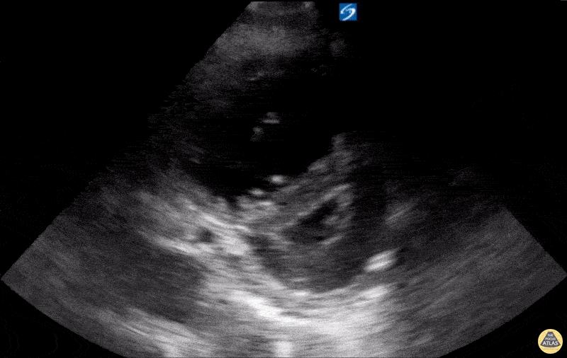Right Ventricular Dysfunction - RV Strain with RV dilation and D-sign on PSSA