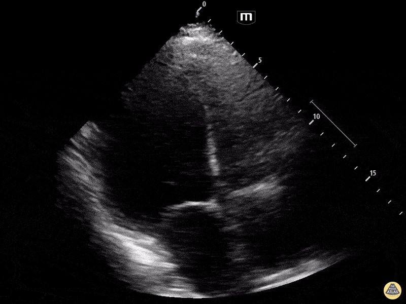 Other Cardiac Pathology - Viral vs. Postpartum Cardiomyopathy A4C