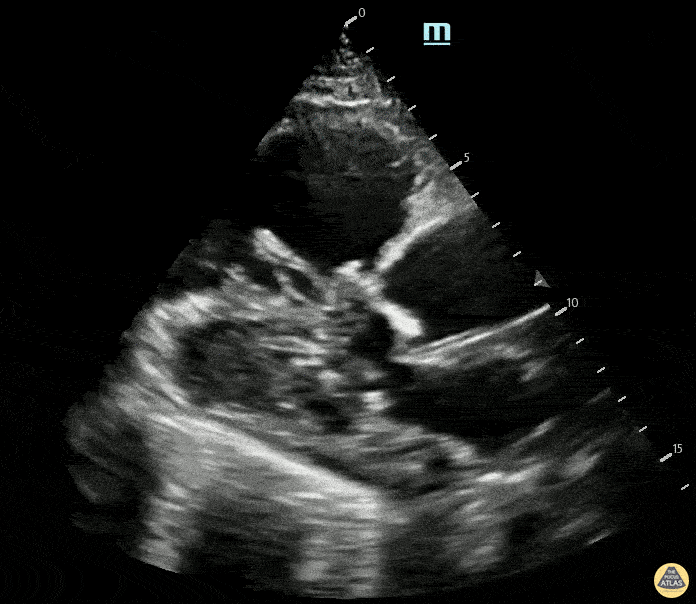 Right Ventricular Dysfunction - PSLA view demonstrating RV dilation and clot in transit