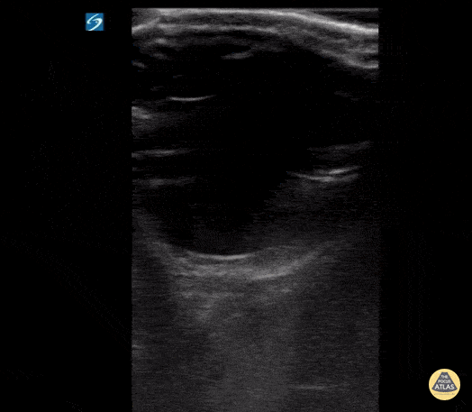 Orbital - Retinal Edema (2/2 - Clip)
