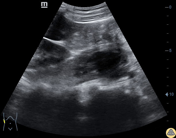 Musculoskeletal - Psoas Abscess