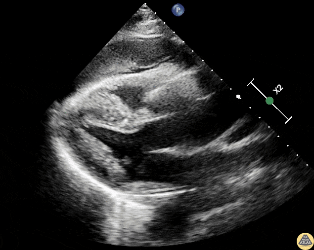 Thoracic Aortic Dissection & Aneurysm - Ascending Aortic Aneurysm with Dissection Flap
