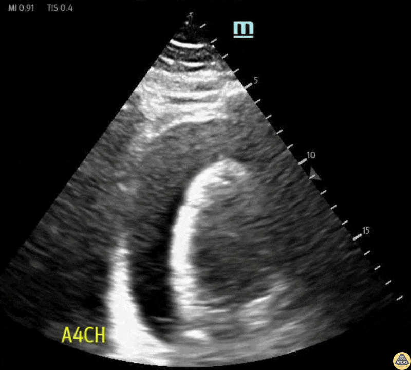 Pericardial Disease - Cardiac Tamponade in Apical 4-Chamber View