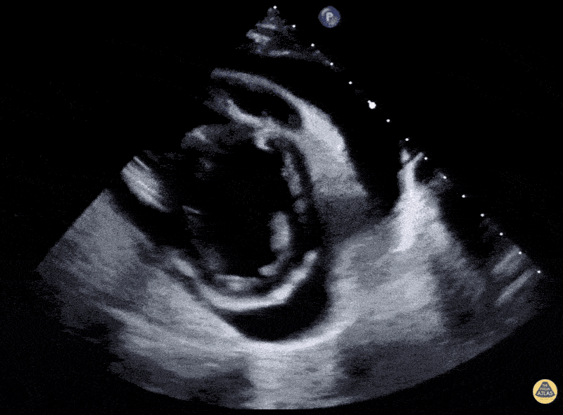 Pericardial Disease - SLE Pericardial Effusion in multiple views