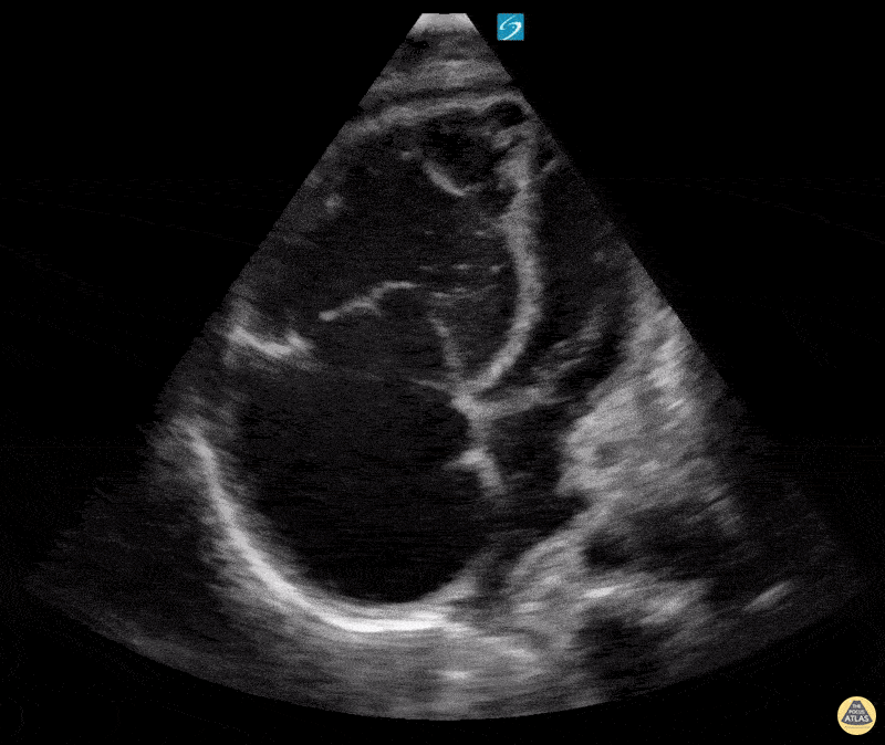 Right Ventricular Dysfunction - Right Heart Strain in Pulmonary Hypertension A4C