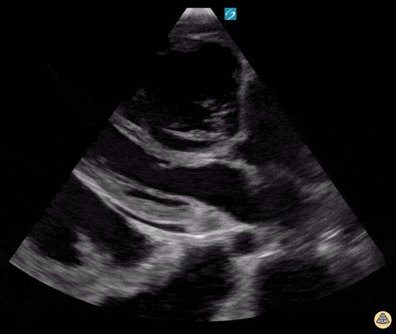 Right Ventricular Dysfunction - Right Heart Strain in Pulmonary Hypertension PSL