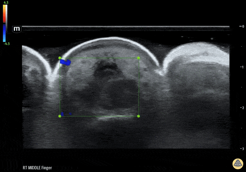 Musculoskeletal - Flexor Tenosynovitis Waterbath Ultrasound - Color Doppler