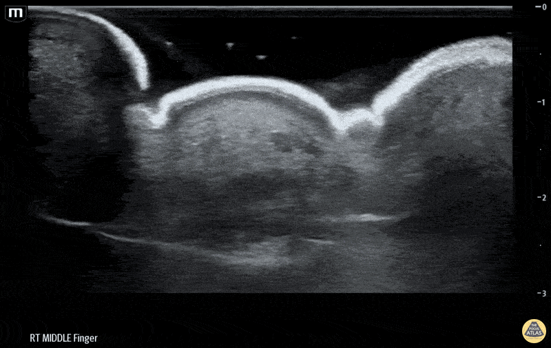 Musculoskeletal - Flexor Tenosynovitis Waterbath Ultrasound - Long axis
