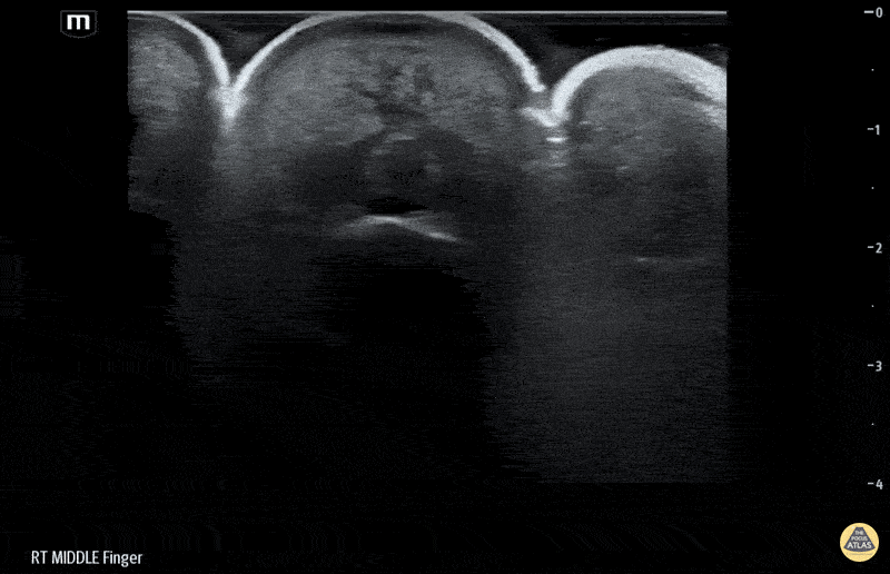 Musculoskeletal - Flexor Tenosynovitis Waterbath Ultrasound - Short axis